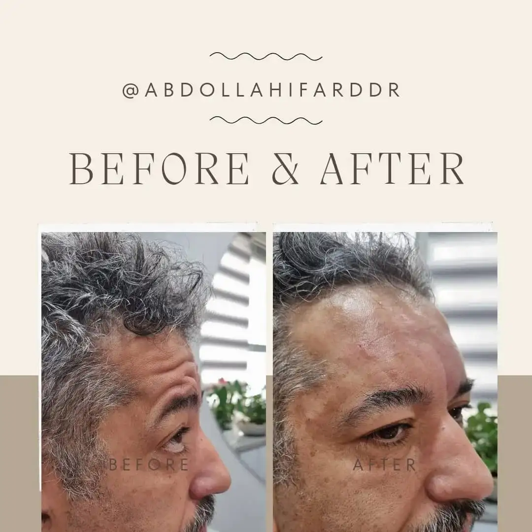 انواع فیلر(ژل)