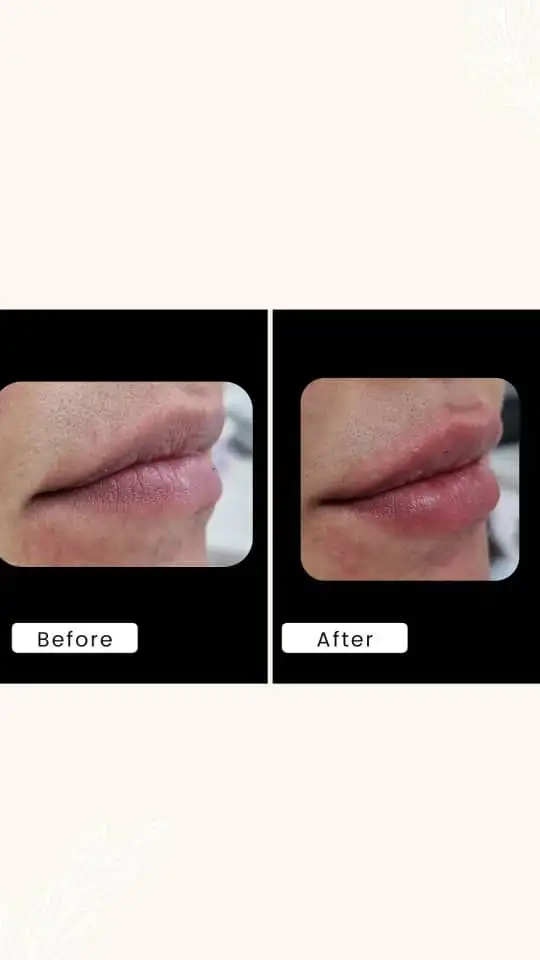 انواع فیلر(ژل)