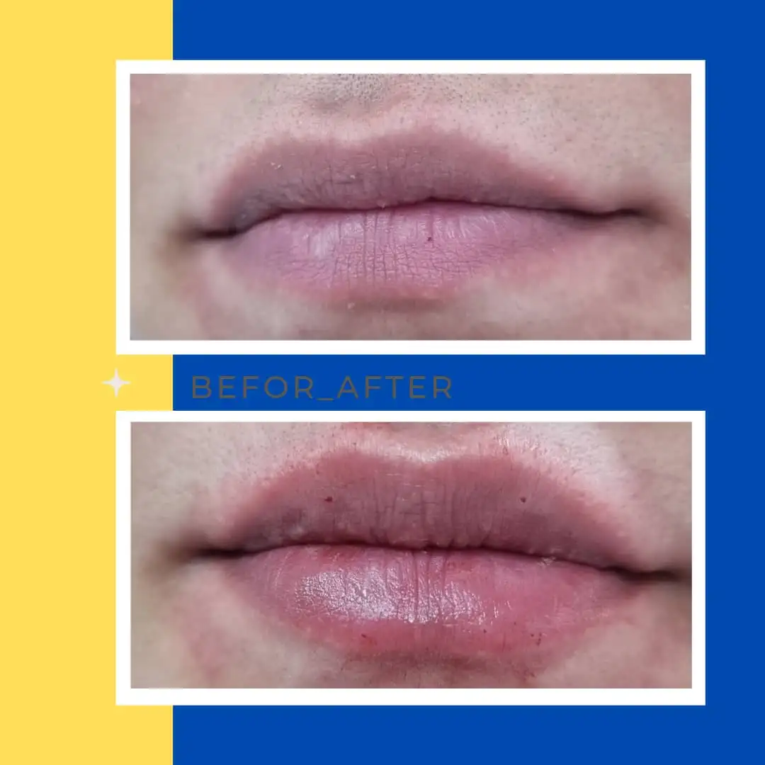 انواع فیلر(ژل)