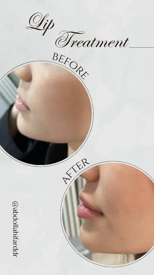 انواع فیلر(ژل)