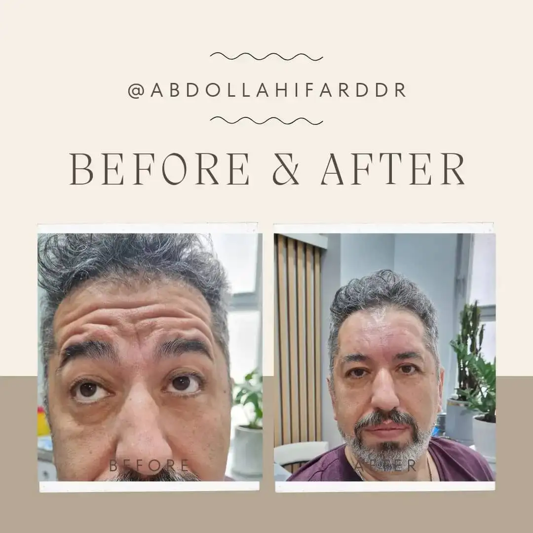 انواع فیلر(ژل)