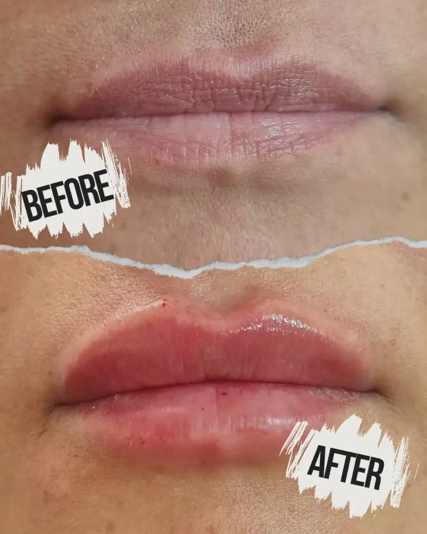 انواع فیلر(ژل)