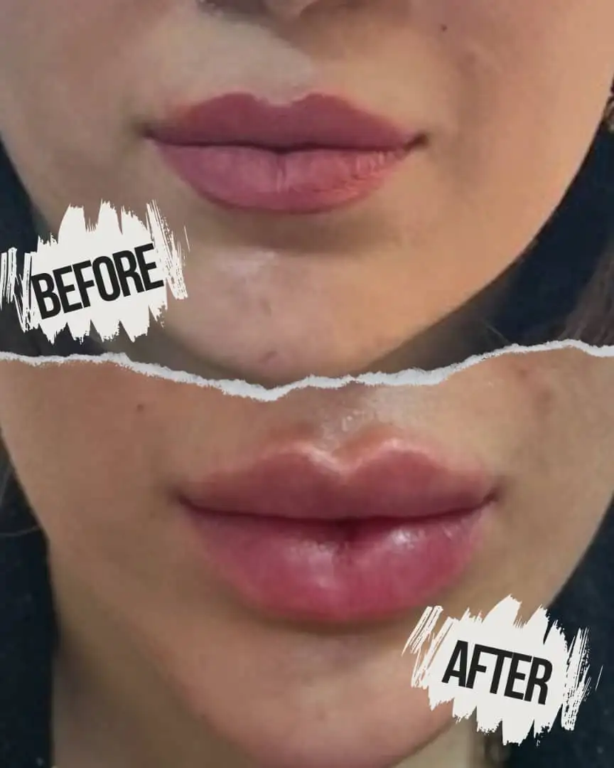 انواع فیلر(ژل)