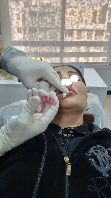 انواع فیلر(ژل)