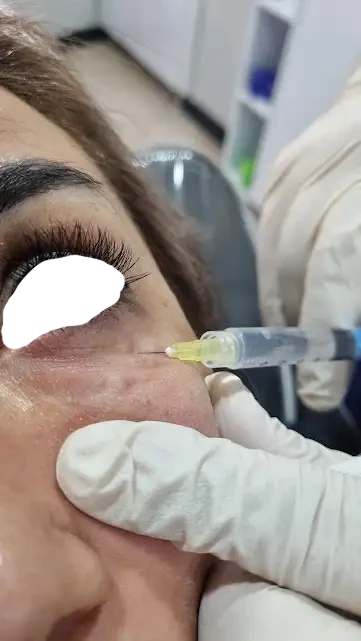 انواع فیلر(ژل)