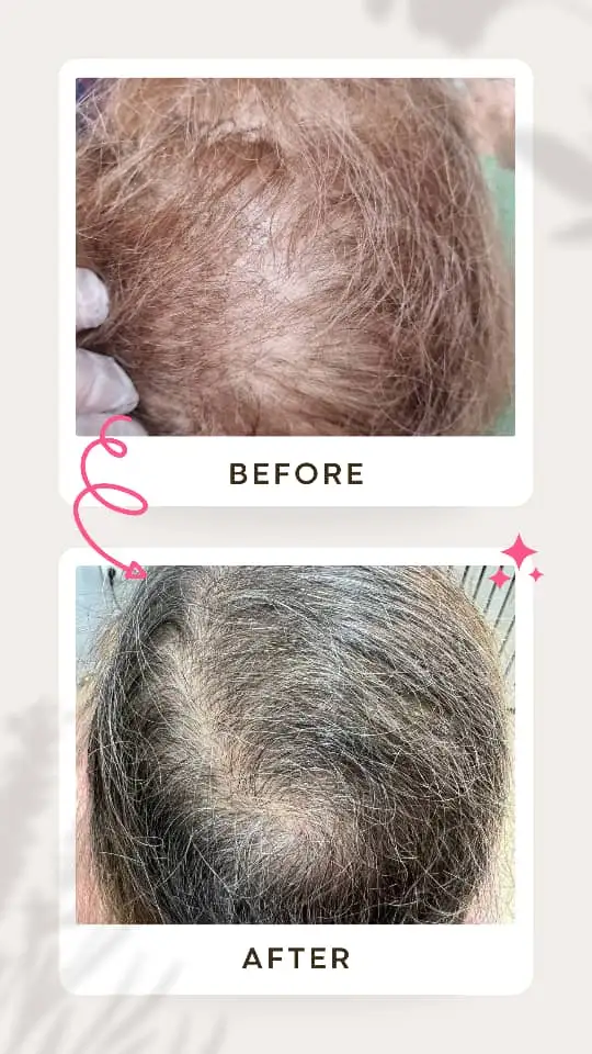 مزوتراپی مو