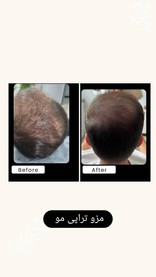 مزوتراپی مو