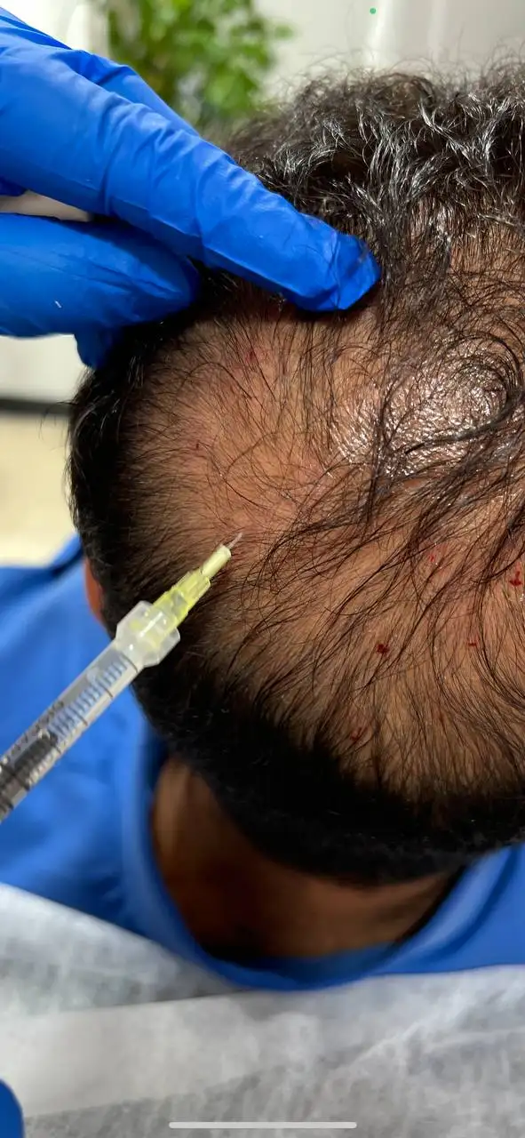 مزوتراپی مو