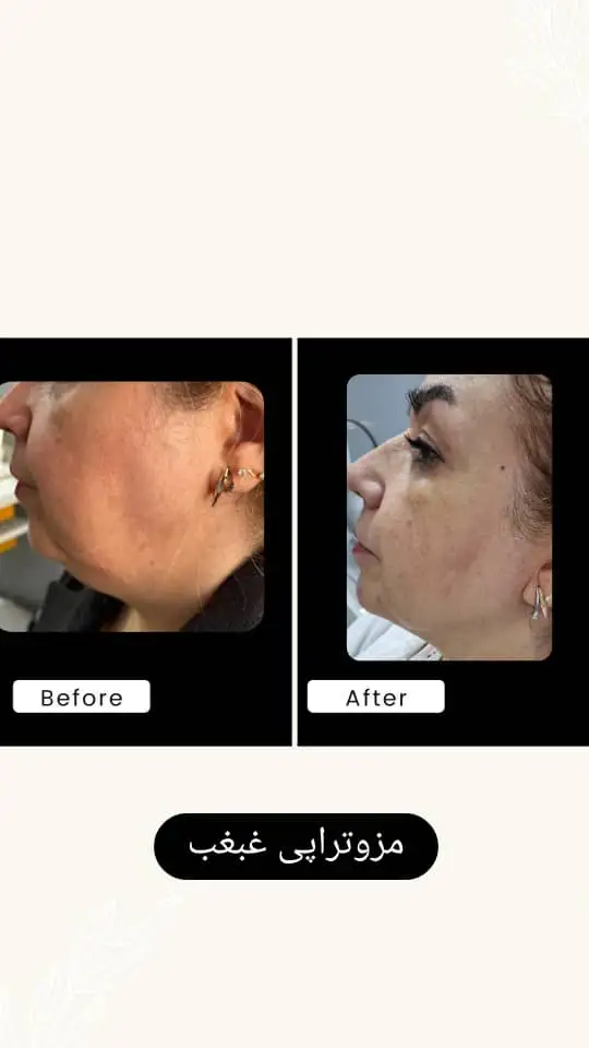 مزوتراپی غبغب