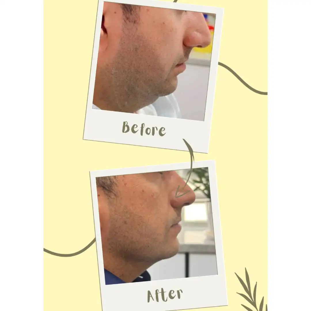 مزوتراپی غبغب