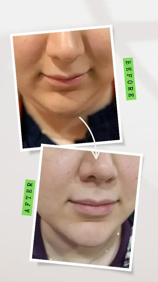 مزوتراپی غبغب