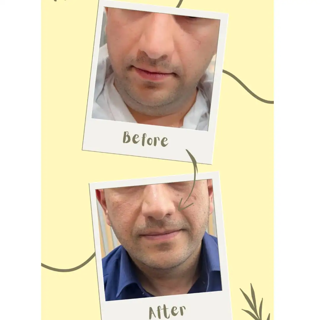 مزوتراپی غبغب