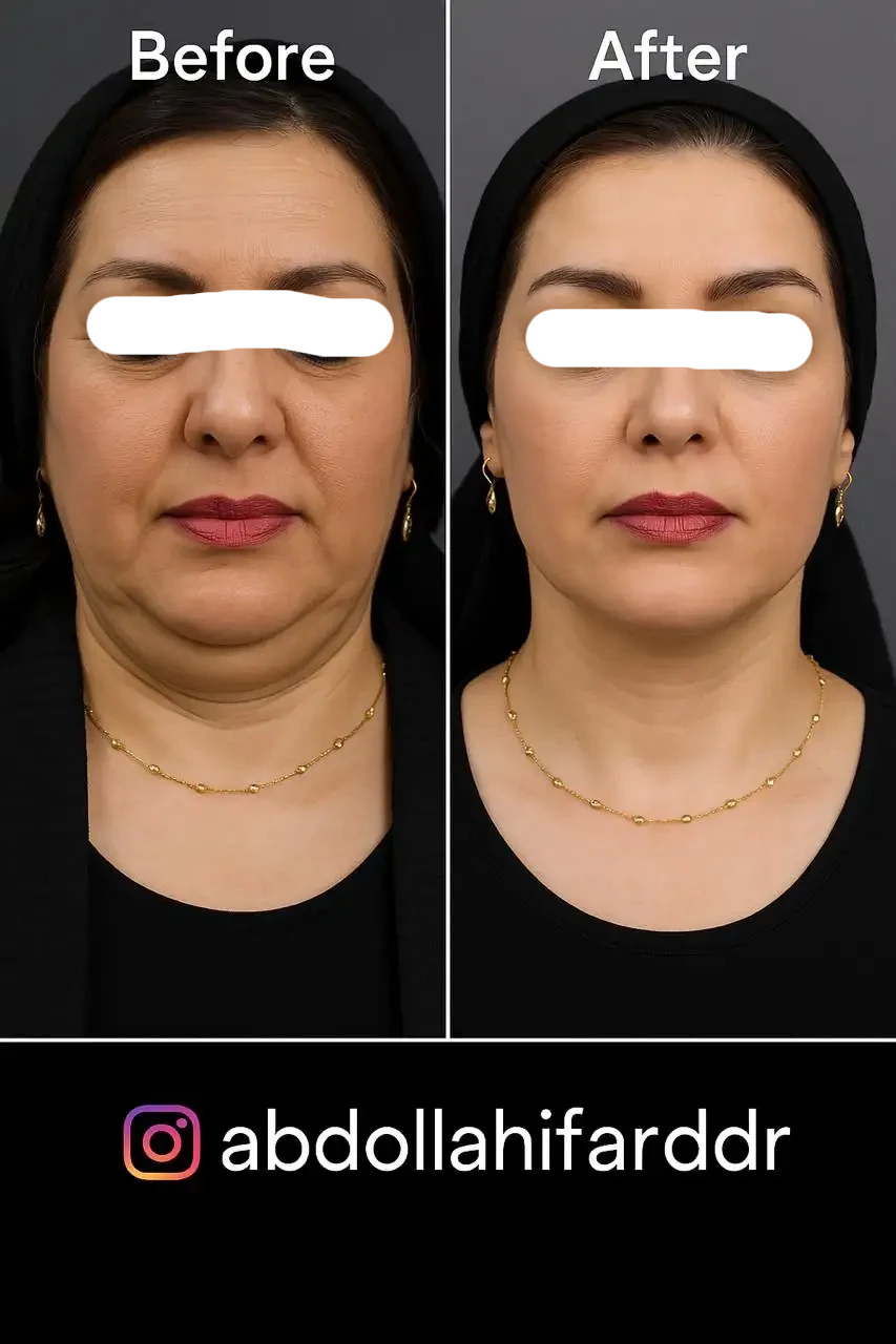 مزوتراپی غبغب