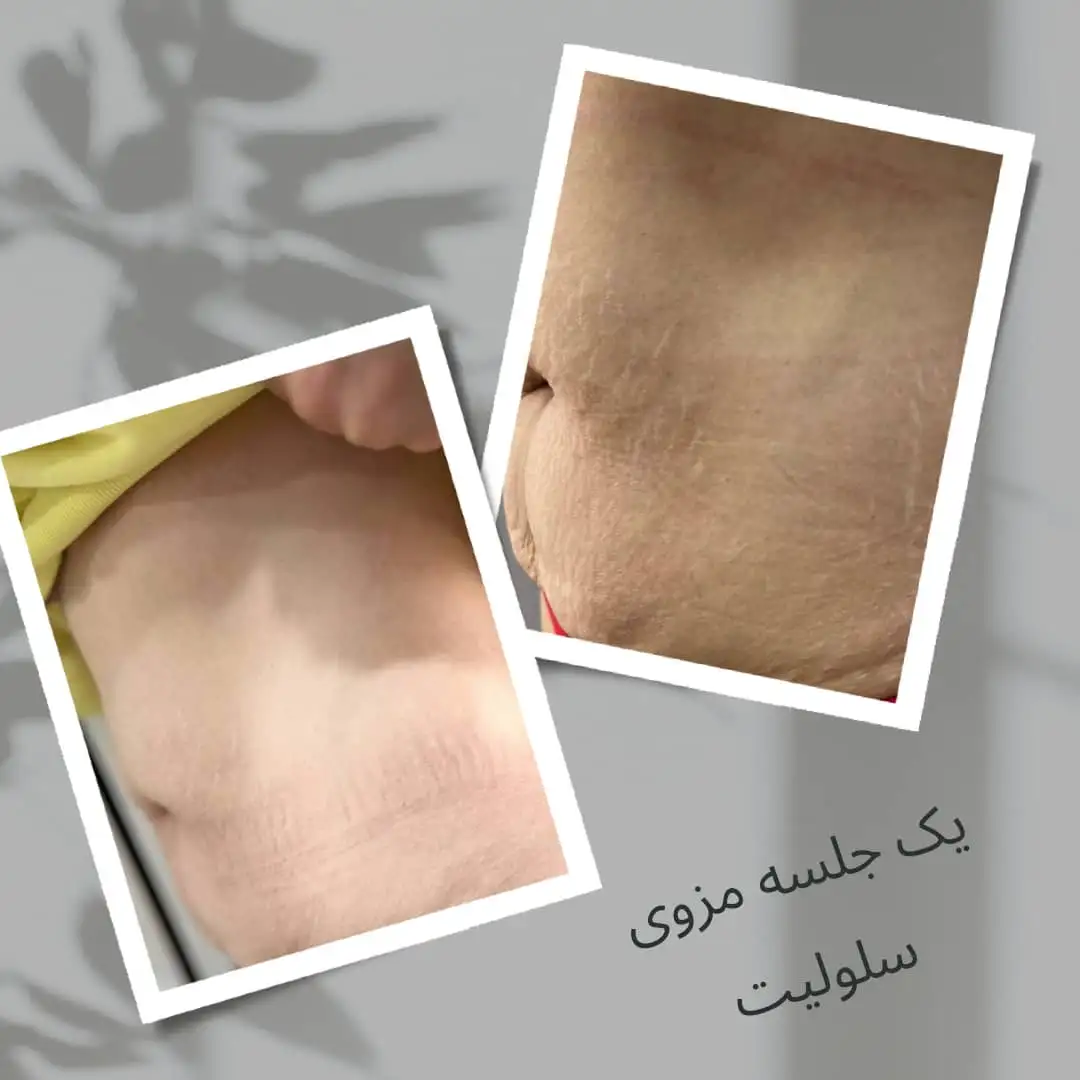 مزوتراپی لاغری