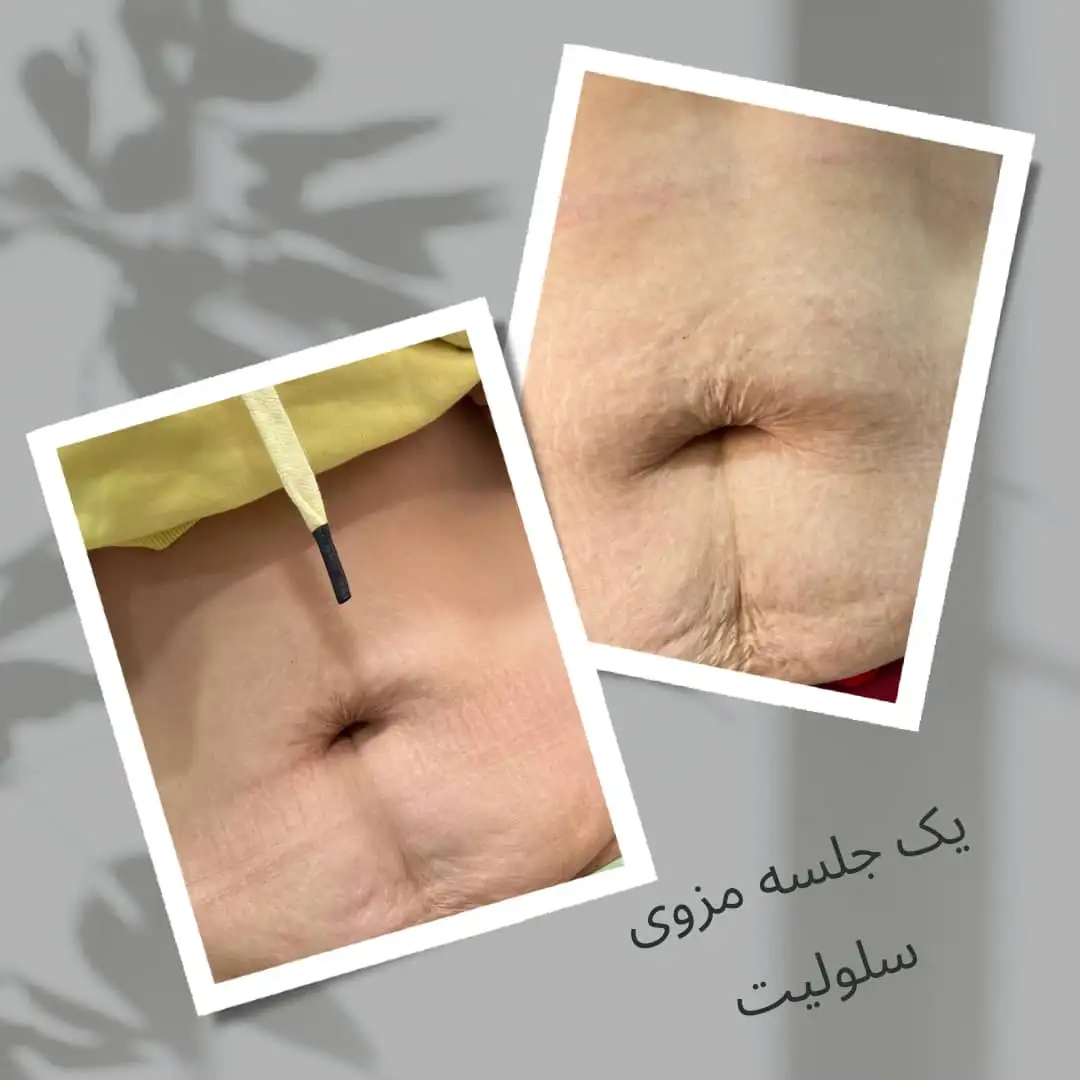 مزوتراپی لاغری