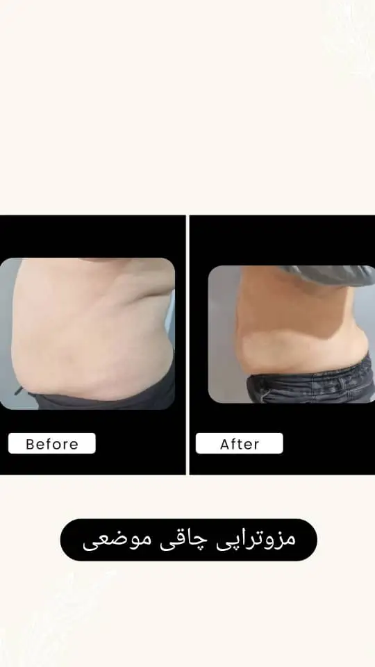 مزوتراپی لاغری