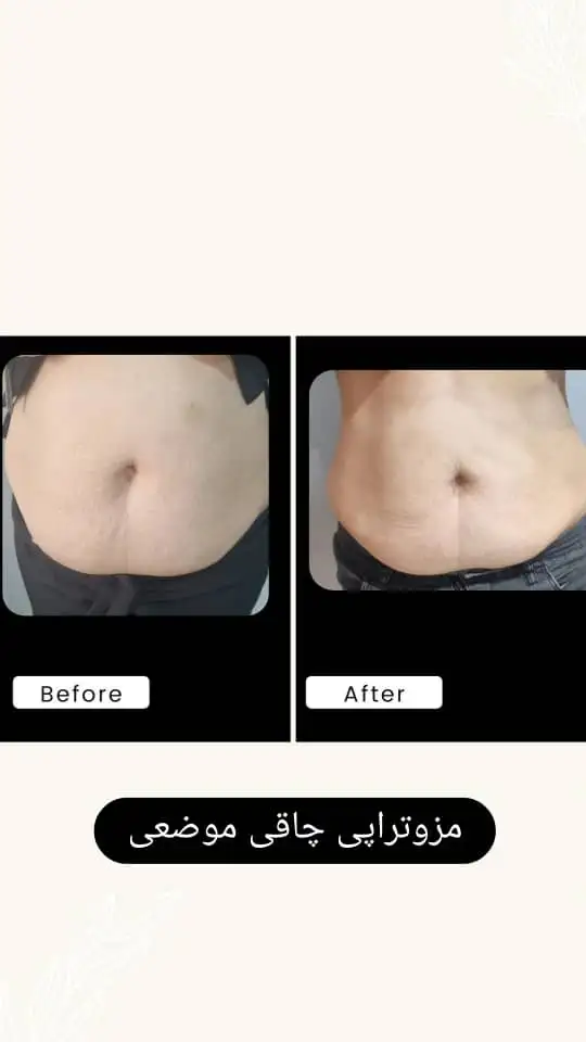 مزوتراپی لاغری