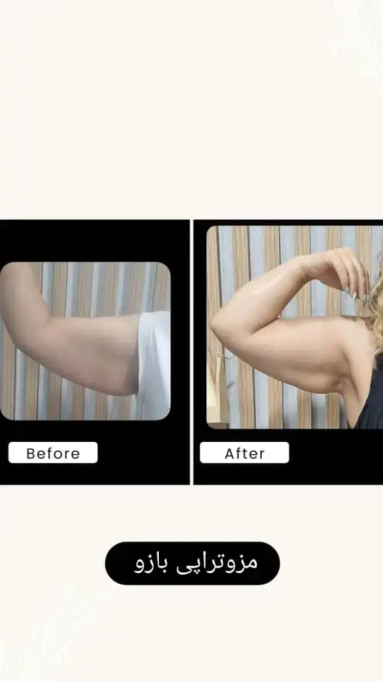 مزوتراپی لاغری