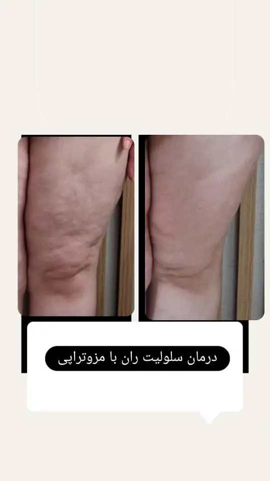مزوتراپی لاغری