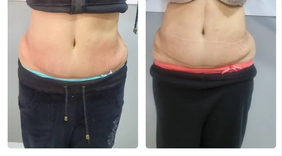 مزوتراپی لاغری