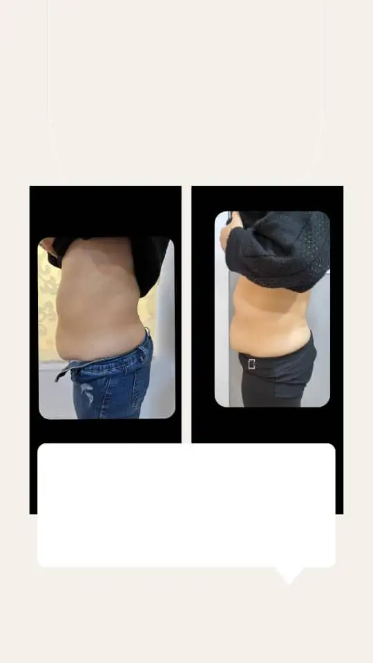 مزوتراپی لاغری