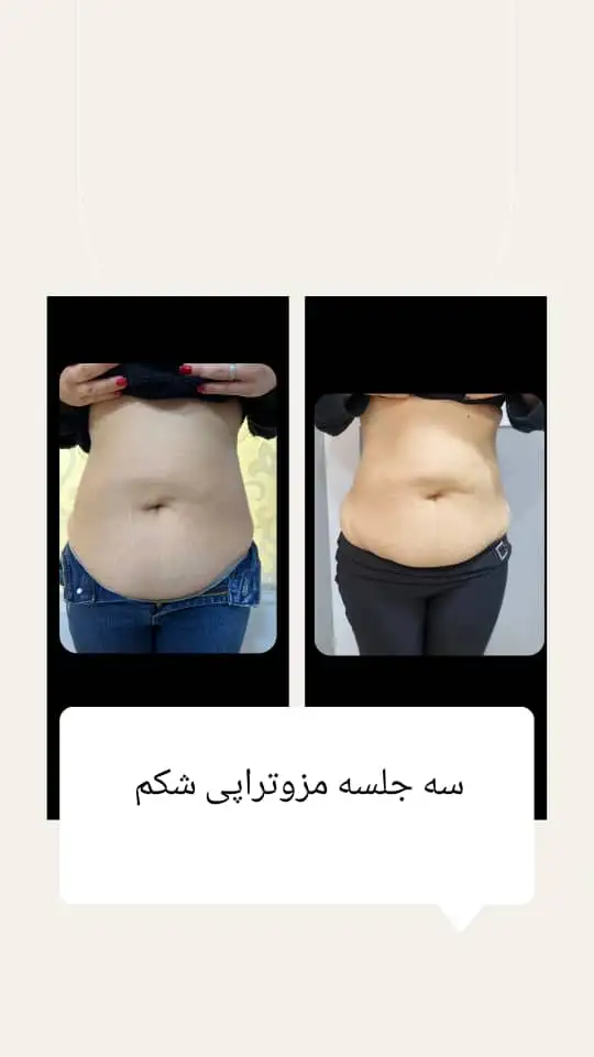 مزوتراپی لاغری